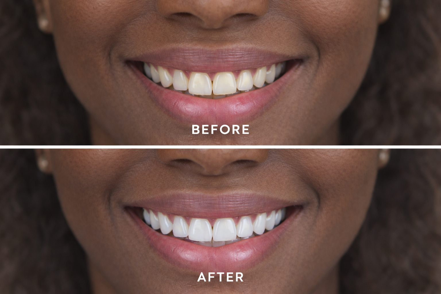 Cosmetic enhancement before and after